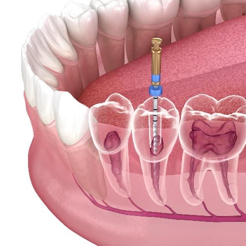 Endodontics